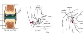 Arthrocentesis